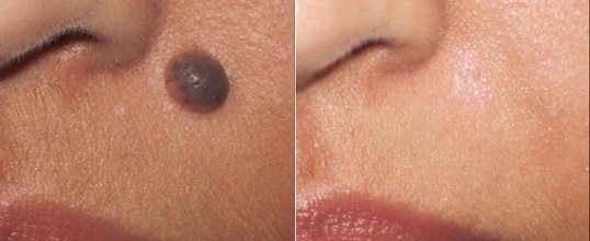 Radiofrequency (RF) Scar-Less Mole Removal